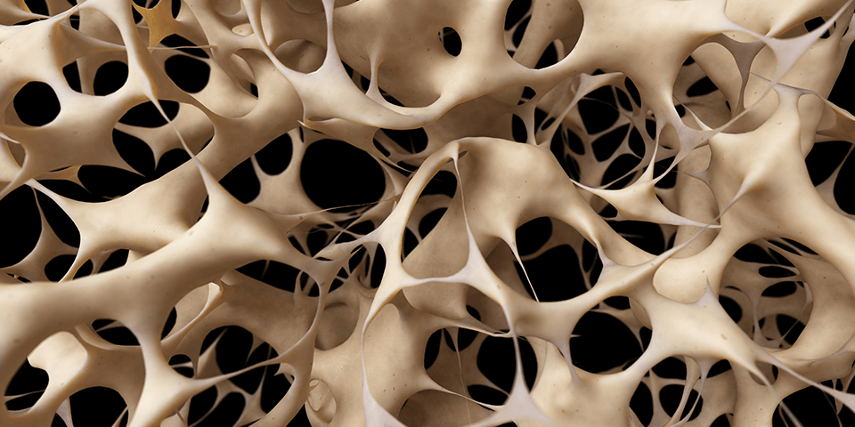 Kriteria Osteoporosis dan Pedoman Klinis (MedUpdate)
