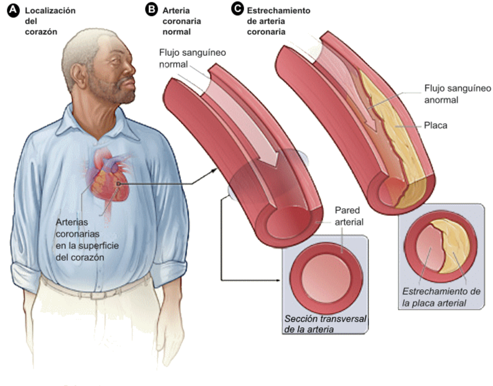 ilustrasi aterosklerosis akibat penumpukan kolesterol yang tinggi