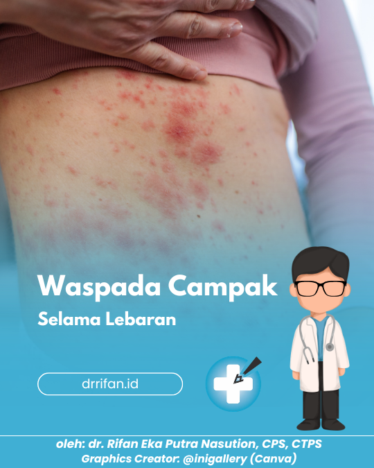 Waspada Campak Selama Lebaran