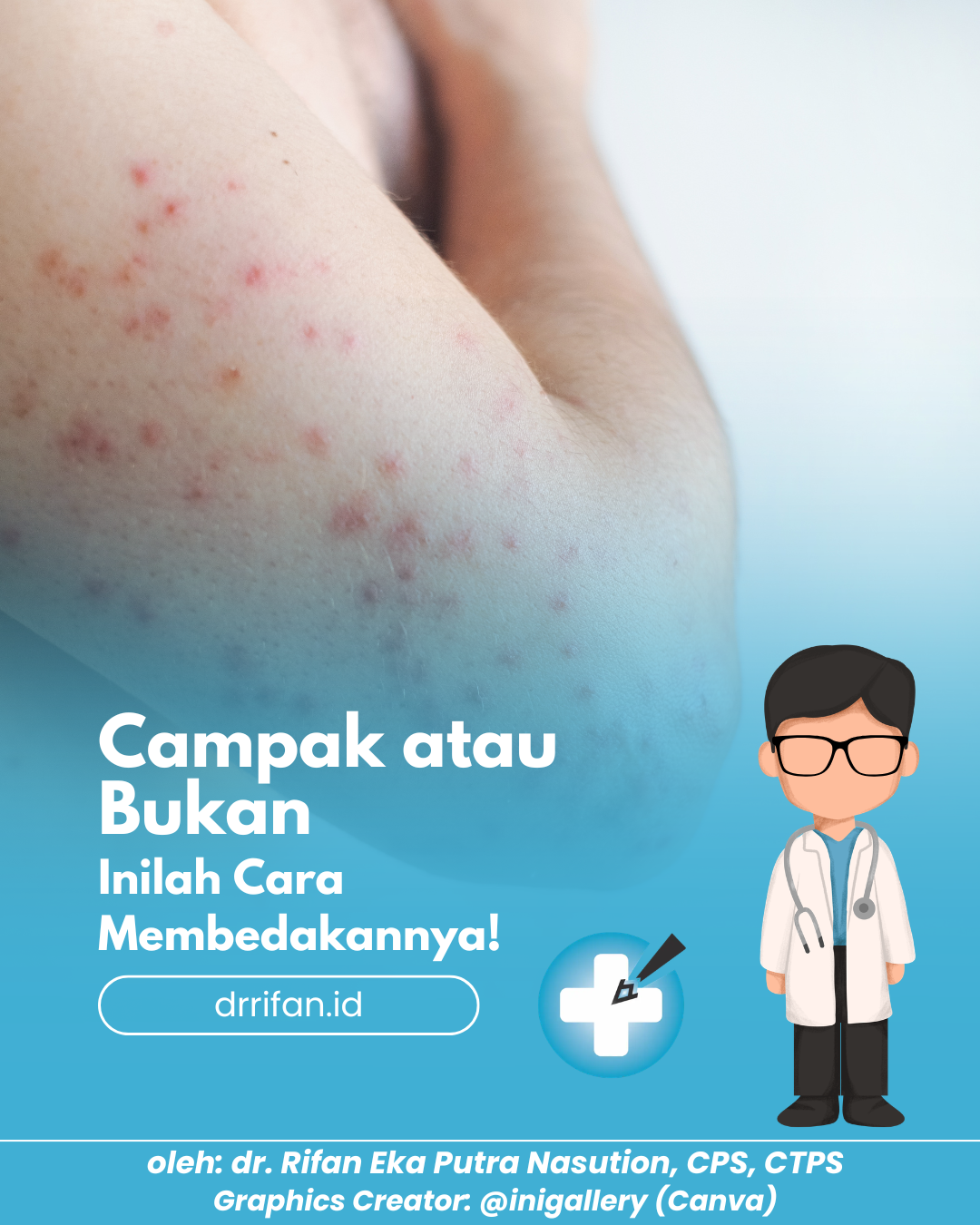 Campak atau Bukan? Inilah Cara Membedakannya!
