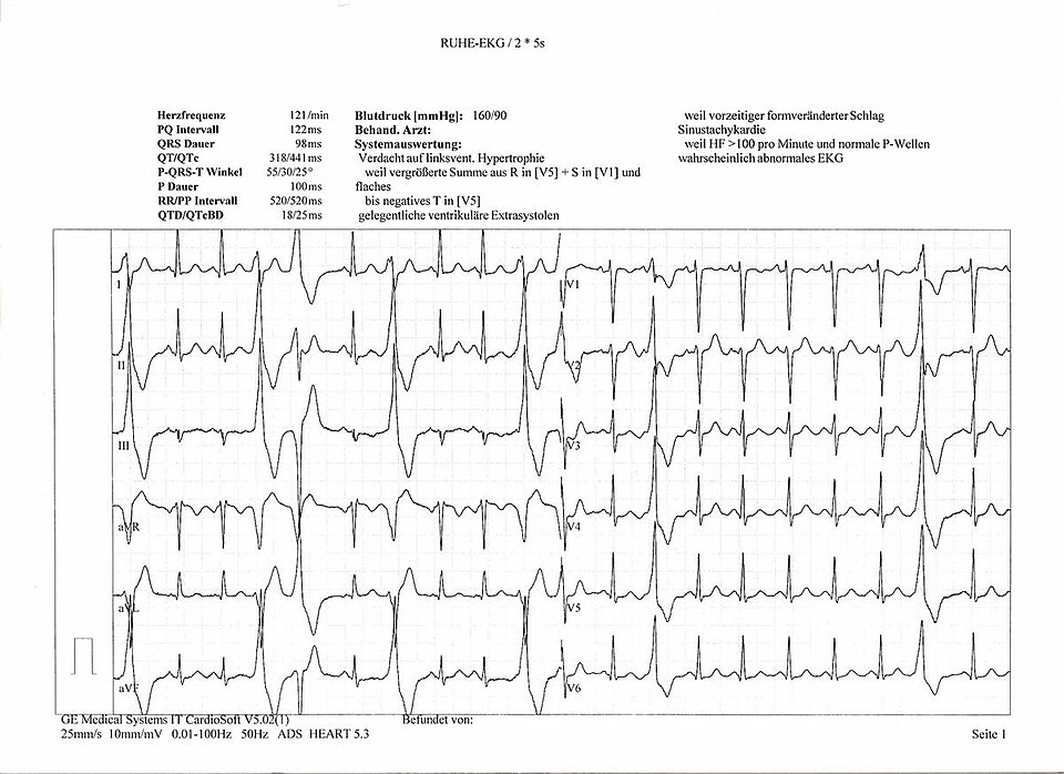 contoh ekg abnormal