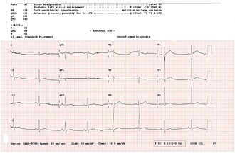 contoh hasil rekaman ekg jantung standar