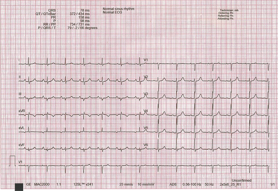 ekg normal pada laki-laki usia 66 tahun