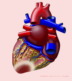 ilustrasi jantung dengan infark posterior