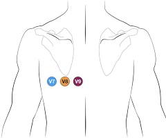 lokasi ekg posterior